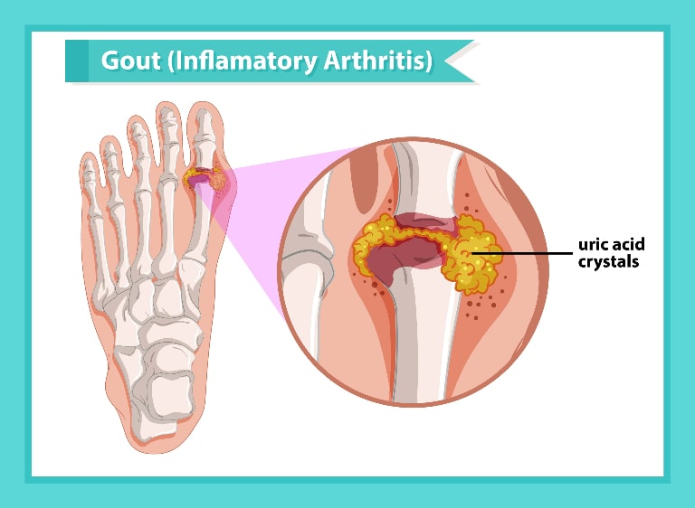 Illustration of inflamed joints caused by gout, a form of arthritis.